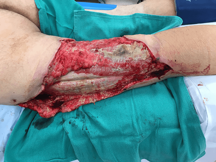 Figure 1. Pre-operative leg wound prior to debridement 