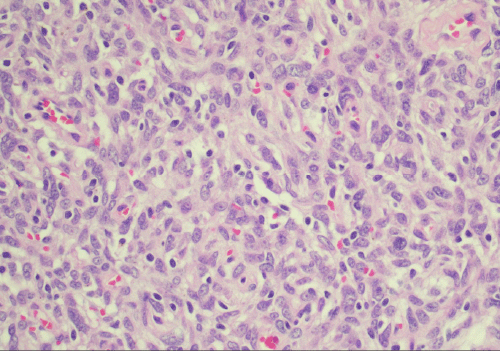 H&E stain, 40x original magnification detailing the cytological features of the lesional spindle cells. The cells exhibit ovoid to spindle-shaped nuclei with irregular nuclear membranes and, in some cells, prominent nucleoli. Extravasated red blood cells are scattered throughout the lesion