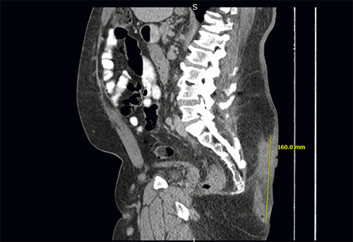 Note large pilonidal mass with associated soft tissue inflammation measuring 16.0 × 4.5 × 4.0 cm. Inflammatory changes extend to the sacral fascia