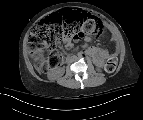 The axial view demonstrates a large fecal burden with associated air trapping