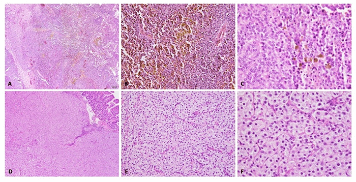 Hematoxylin and eosin-stained sections of metastatic melanoma. (A) Gallbladder involvement, low power (40X), showing sheets of atypical cells. (B) Gallbladder, medium power (200X), detailing cellular morphology. (C) Gallbladder, high power (400X), highlighting nuclear atypia and prominent nucleoli. (D) Jejunal involvement, low power (40X), showing tumor infiltration. (E) Jejunum, medium power (200X). (F) Jejunum, high power (400X), demonstrating similar cytological features to the gallbladder metastasis