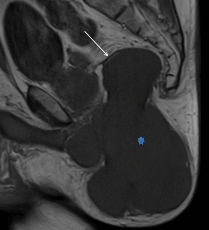 The large pelvic neurofibroma (asterisk) distorts and displaces the levator ani muscle (white arrow)