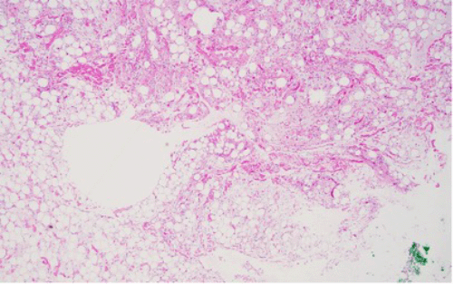 At 40x magnification, an admixture of mature adipocytes, occasional lipoblasts (immature fat cells with vacuolated cytoplasm and scalloped nuclei), and a myxoid to fibrous stroma is highlighted