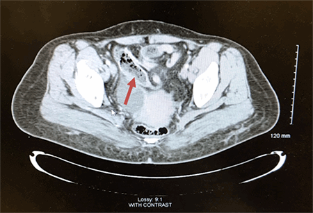 Figure 1. CT and pelvis showing appendix with fecalith located in the anterior paracentral pelvis