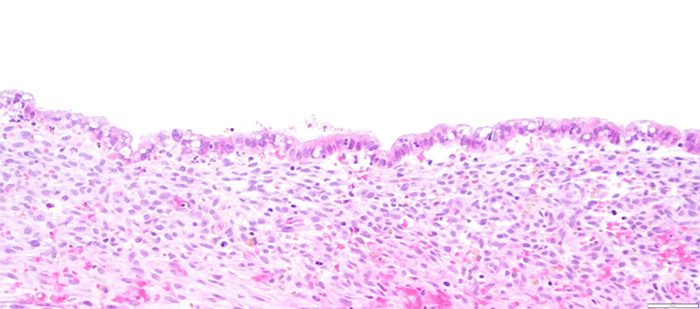 H&E stain demonstrates a cyst lined by a single layer of cuboidal to columnar epithelium with morphology resembling endometrium. Subepithelial stroma containing foci of hemorrhage and hemosiderin-laden mast cells is also evident