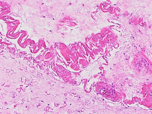 A) 2x: Tumor contained broad collagenous areas with interspersed benign lipomatous elements