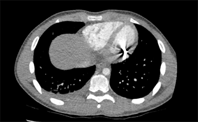 Figure 4. Axial view depicting bullet inside the left ventricle.
