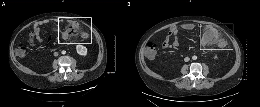 A) CT showing intraperitoneal free air suggesting microperforations; and B) days later, showing 5 cm interval abscess adjacent to jejunum.