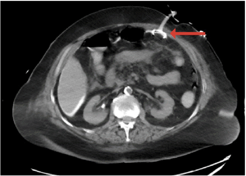 B) Percutaneous endoscopic gastrostomy (PEG) tube button outside gastric lumen (red arrow)