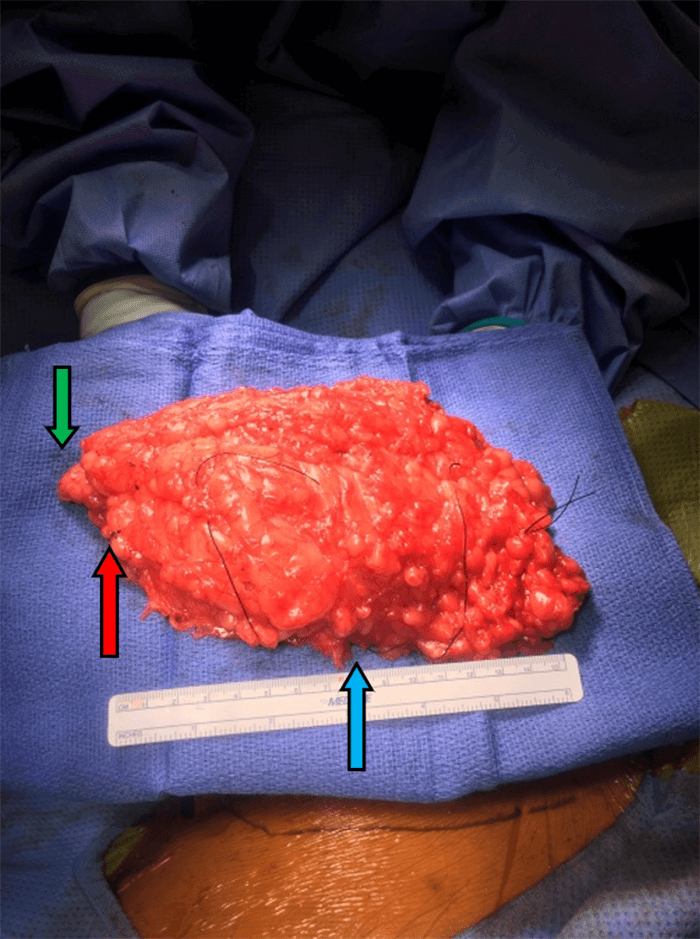 Figure 2. A: Excised tumor specimen en bloc with surrounding fat and muscle fascia. The great saphenous vein is encased in the tumor and the inferior tied edge of the vein is marked by the red arrow. Green arrow marks inferior resection margin, blue arrow marks lateral margin.