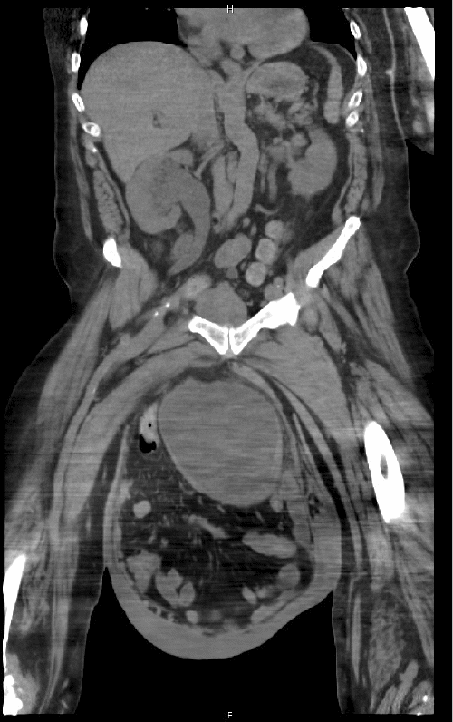 B) Bladder, small intestine, large intestine, and both ureters are herniated and located within the scrotal sac.