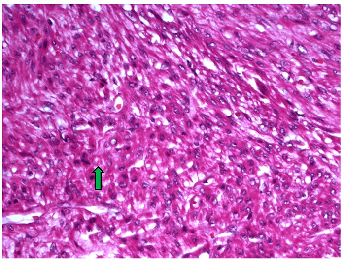 Figure 3. B: High powered field of the leiomyosarcoma displaying mitotic figures. Green arrow marks mitotic figure.