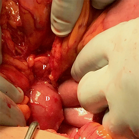Figure 6. The duodenum (D) does not cross midline, with the head of the pancreas (P) readily visible and protuberant out from the retroperitoneum. 