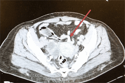 Figure 2. Vermiform appendix shown in paracentral pelvis