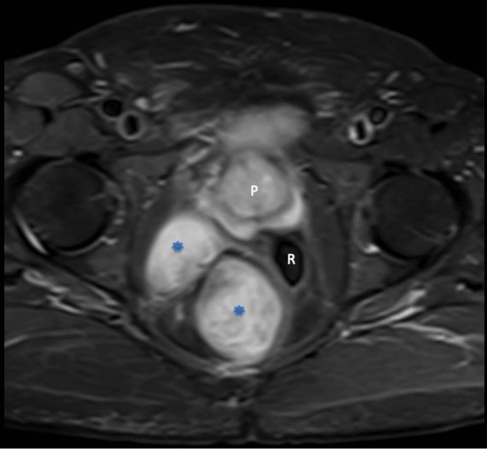 The large pelvic neurofibroma (asterisk) causes mass effect and leftward displacement of the rectum (R). The mass also distorts the right peripheral zone of the prostate (P) without evidence of tumor invasion