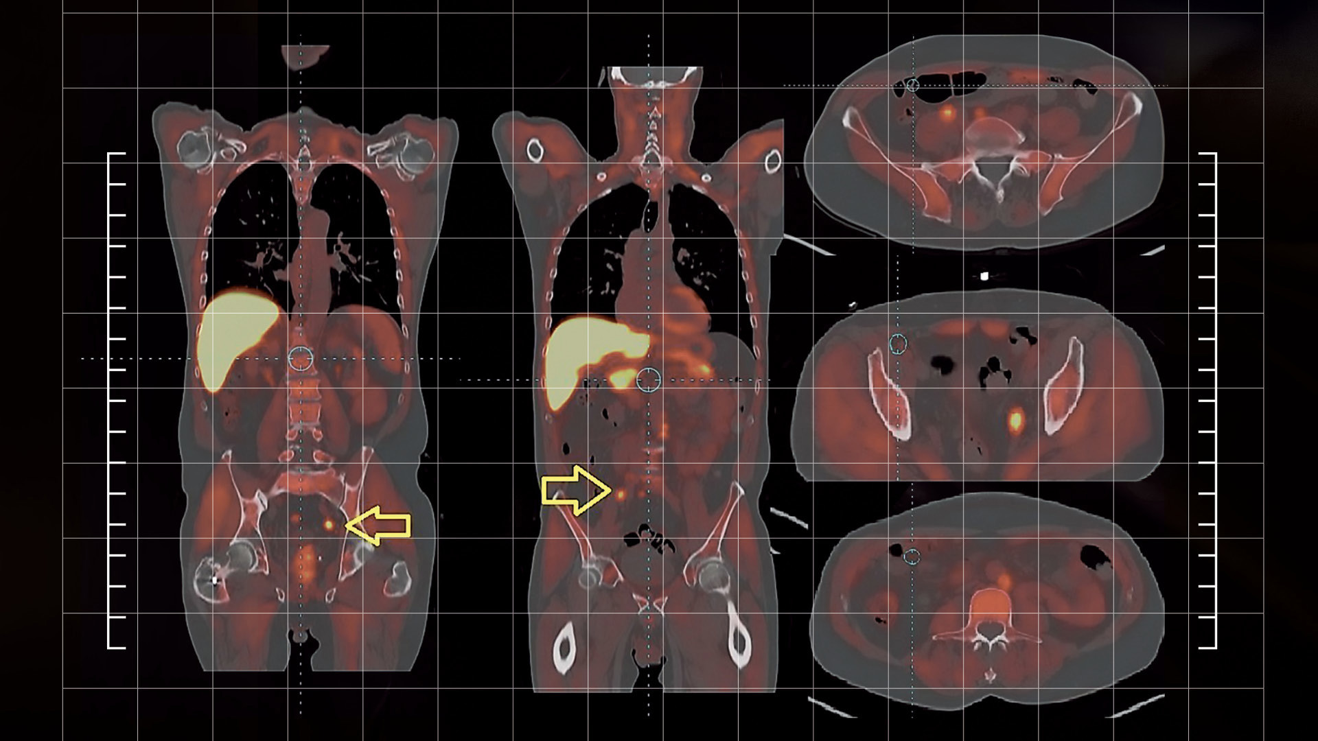 A PSMA PET scan vividly highlights the location of prostate cancer.