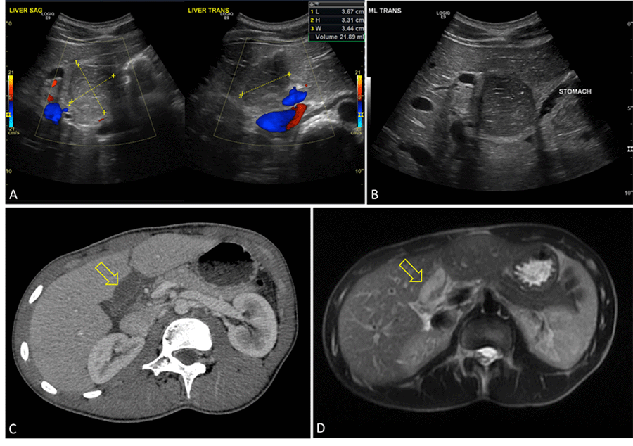 A) Oval collection in porta hepatis isoechoic relative to liver parenchyma measuring 3.6 × 3.3 × 3.4 cm; B) Mass in subhepatic space, anterior to distal end of stomach; C) CT with cystic lesion and small amount of surrounding fluid; D) T2 MRI with cystic mass, slight mural thickening. No communication to biliary tree was found on magnetic resonance cholangiopancreatography.