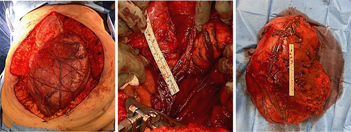 From left to right: Well-encapsulated, attenuated colonic mesentery; prominent vessels around the periphery of the tumor (up to 1 cm diameter); final specimen dimensions: 46 × 31 × 15 cm