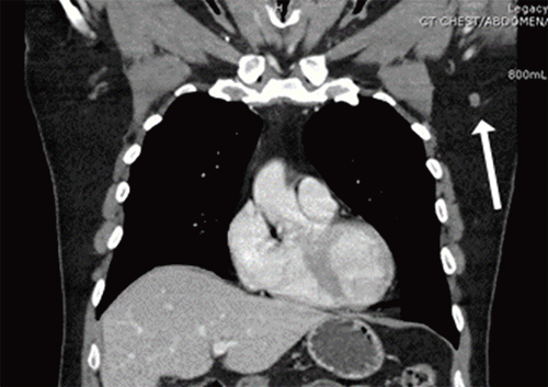 Images demonstrate an enlarged lymph node in the left axilla (1.1 × 0.8 cm), raising concern for metastasis
