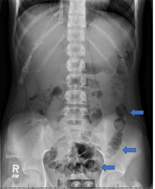 Abdominal X Ray Suggestive of Colon Containing Stool (blue arrows). 