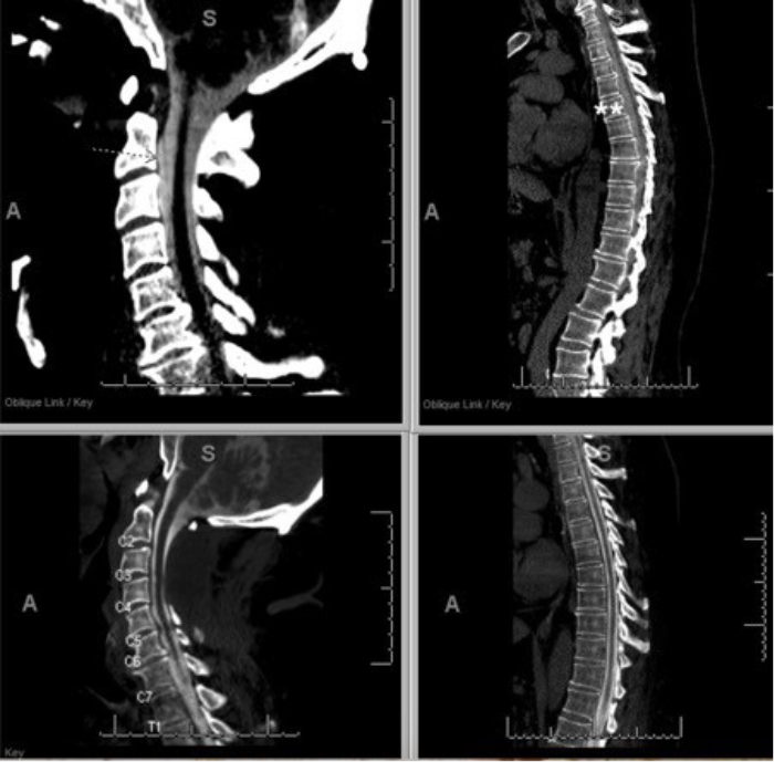 Preoperatively (top left), a separate fluid collection (arrow), distinct from the thecal sac and ventral to the spinal cord, represents the pseudomeningocele. Preoperative myelogram (top right) also demonstrates severe thoracic spinal cord compression. Postoperatively (bottom left), the cervical myelogram shows near-complete resolution of the ventral pseudomeningocele, with corresponding improvement in thoracic spinal cord compression (bottom right).