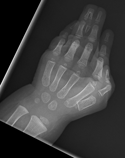 Figure 6. Preop x-ray showing complex complete syndactyly with bony synostosis.