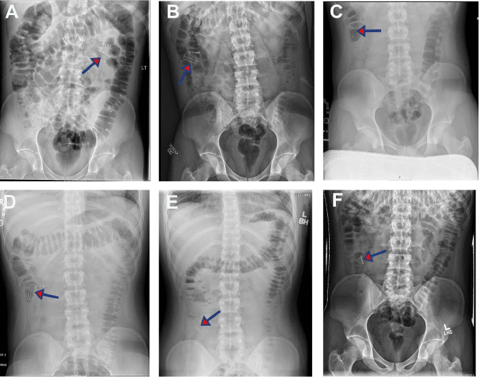 Sequential KUB images were acquired at approximately (A-B, arrow) 16, (C-E, arrow) 36, and (E, arrow) 48 hours post-presentation, which revealed movement of the needle from early segments of the small bowel presumably to the ascending portion of the colon