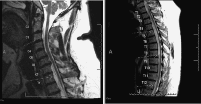 Note extensive ventral pseudomeningocele extending from C2 to L1 (arrows) with significant thoracic cord compression