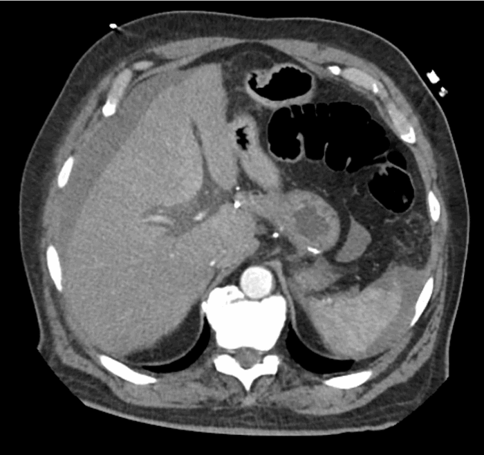 Figure 3. Large amount of hemoperitoneum throughout the abdomen.