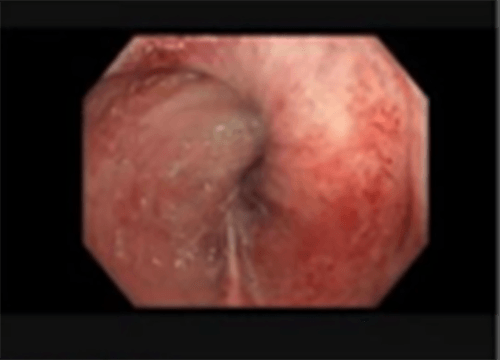 Figure 4. Endoscopic view showing pinwheeling of the twisted pouch (2018)