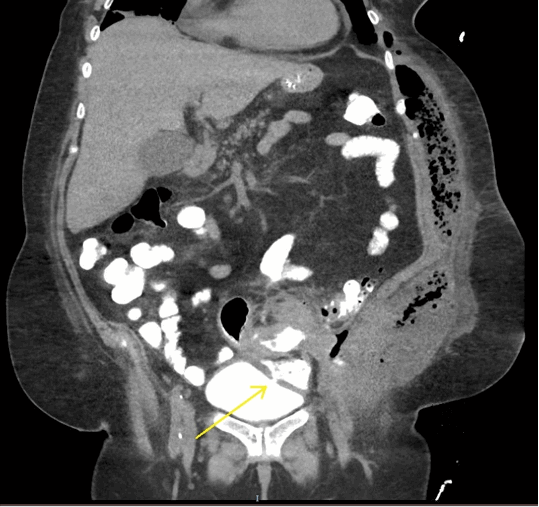 Figure 2. Enteric contrast opacifies the bladder with a fistulous connection to sigmoid colon (yellow arrow).