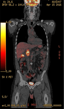 Figure 2: PET scan demonstrating a hypermetabolic mass in the gallbladder fundus and activity in the porta hepatis.