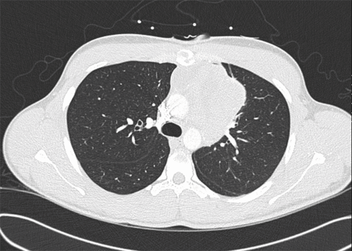 Pulmonary nodules 11.0 × 9.0 mm left posterior apical juxtapleural, 2.0 mm left anterior upper lobe, and 3.0 mm subpleural left lower lobe were also noted