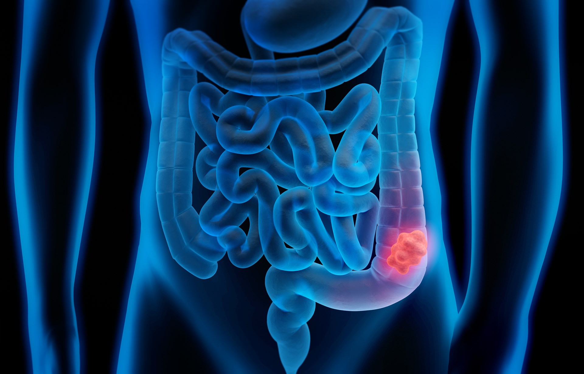 Rectal Bleeding in Young Adults Linked to 8.5 Times Higher Risk of Colorectal Cancer