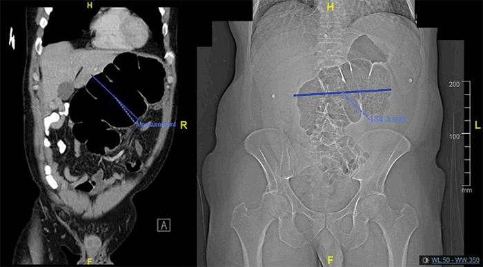 Figure 1. Congenital malrotation of the bowel with cecal volvulus measuring 13 cm in size