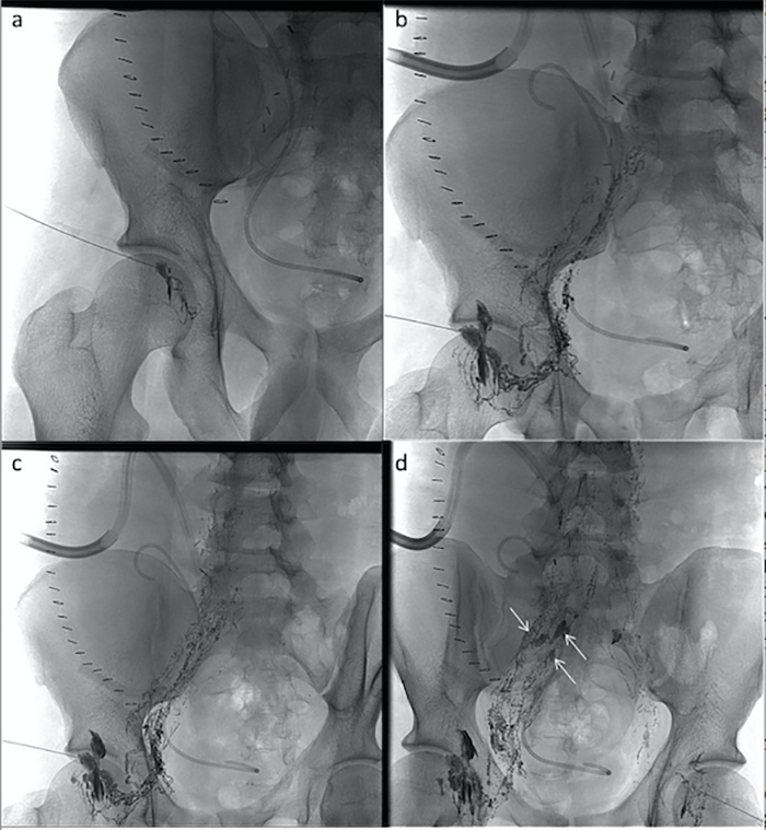 Figure 1. A, B, C: Bilateral inguinal approach lymphangiogram of the pelvis exhibits progressive opacification of the bilateral iliac lymphatic chains; D: Foci of leak in the right pelvic retroperitoneum, adjacent to the double-J stent in the transplanted ureter, represents sites of lymphatic leakage