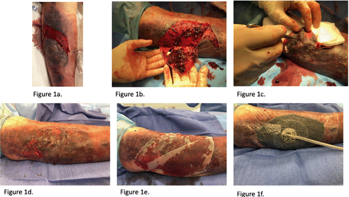 A) The presentation of the wound with the skin changes and significant clot burden under the skin flap. B) The skin flap after the clot underneath has been debrided. C) The skin flap was left with a skin bridge and meshed using a scalpel. D) The meshed skin flap was refitted and stapled peripherally around the wound edge. E) Adaptec placed over the wound for eventual covering with F) wound vac at 125 mm Hg