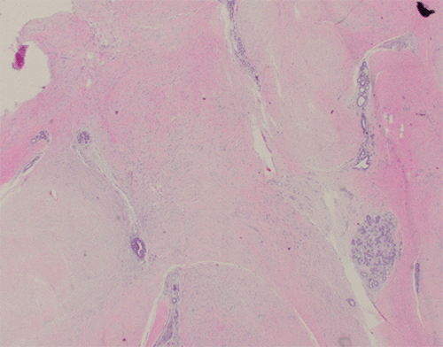 A) A low-power view of the lesion revealed variably cellular fascicles of spindle cells with a collagenous stromal background replacing most of the normal breast tissue