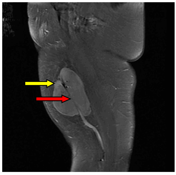 Figure 1. A: Sagittal MRI view of the tumor with the Great Saphenous Vein. Red arrow marks great saphenous vein, yellow arrow marks tumor margin.