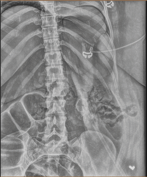 Imaging confirms the presence of free intraperitoneal air
