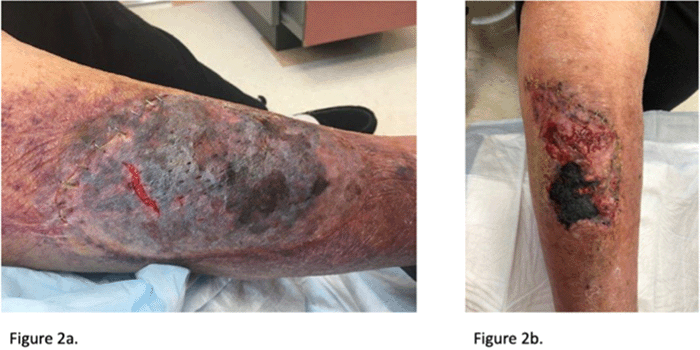 A) The wound appearance five days after in situ autologous skin graft. B) The wound appearance 14 days after in situ autologous skin graft