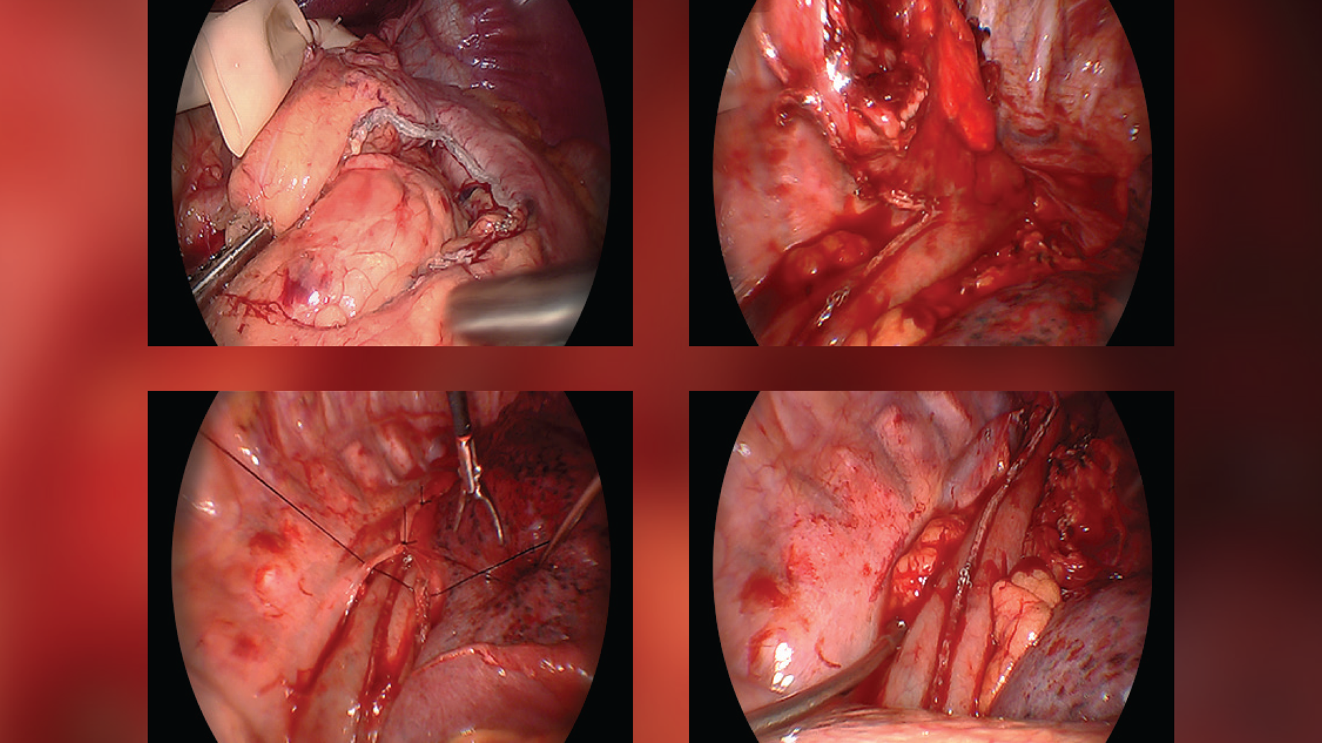 Surgeons Are Humanizing the Esophagectomy