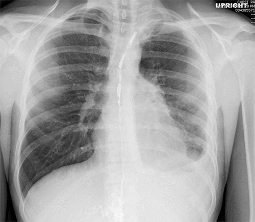 Improved left pleural effusion after repeat thoracic duct embolization