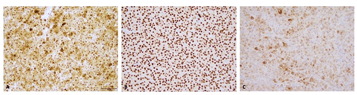 Immunohistochemical stains performed on the jejunal metastasis (all images at 200X magnification). (A) Diffuse, strong nuclear and cytoplasmic staining for S100. (B) Strong, diffuse nuclear staining for SOX10. (C) Diffuse cytoplasmic staining for Melan A. These findings are consistent with a melanocytic origin