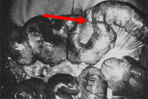 Reproduced from Herrington JL Jr. Scleroderma as a cause of small-bowel obstruction; successful treatment of a case by intestinal resection. AMA Arch Surg. 1959;78(1):17-24 with permission from JAMA Surgery