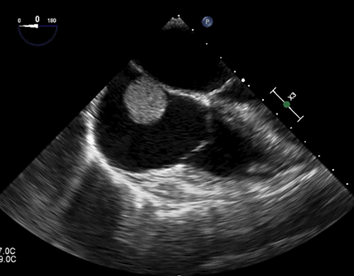 Figure 1: Echocardiogram performed at presentation, showing the right atrial mass.