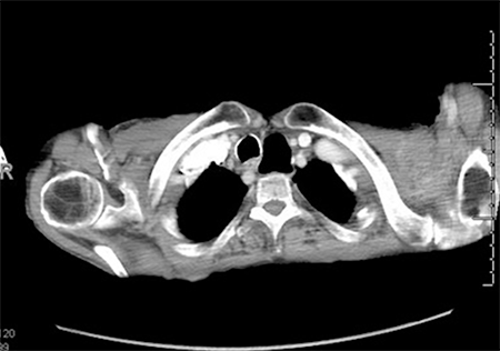 Figure 1. CT scan of the chest with contrast showing the aberrant right subclavian artery and its proximity to a large esophageal diverticulum.