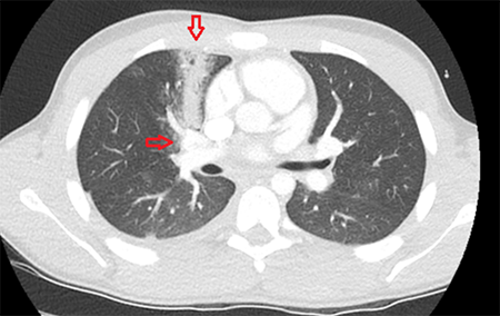 Figure 5. Axial view depicting bullet track near the pulmonary veins.