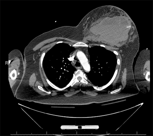 Active arterial extravasation from a branch coursing along the anterolateral chest wall
