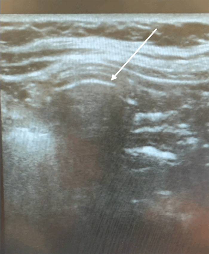 The arrow denotes the interface between the tip of the gastrostomy tube and the stomach mucosa